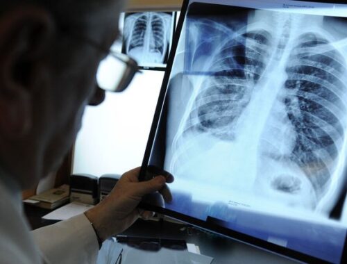 Врач Русакова: число умерших от туберкулеза за 10 лет уменьшилось почти на 70%
